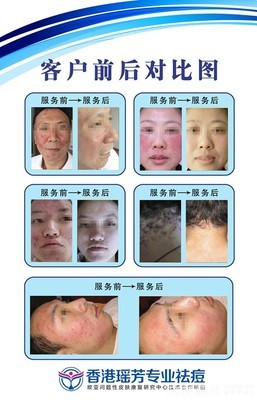 【香港瑤芳9點(diǎn)9元祛痘團(tuán)購】_泉州國貿(mào)商城香港瑤芳專業(yè)祛痘團(tuán)購10元_糯米麗人團(tuán)購